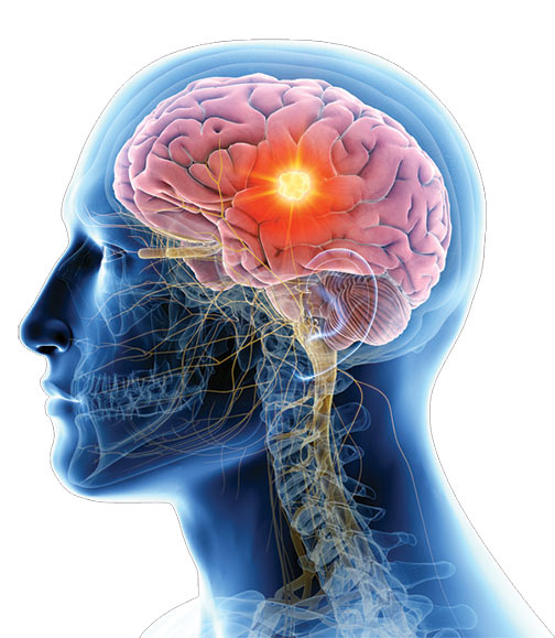 Couer-d-Alene-Spine-and-brain-jeffrey-larson-md-neurosurgeon-brain-tumor-Gamma-Knife-Radiosurgery