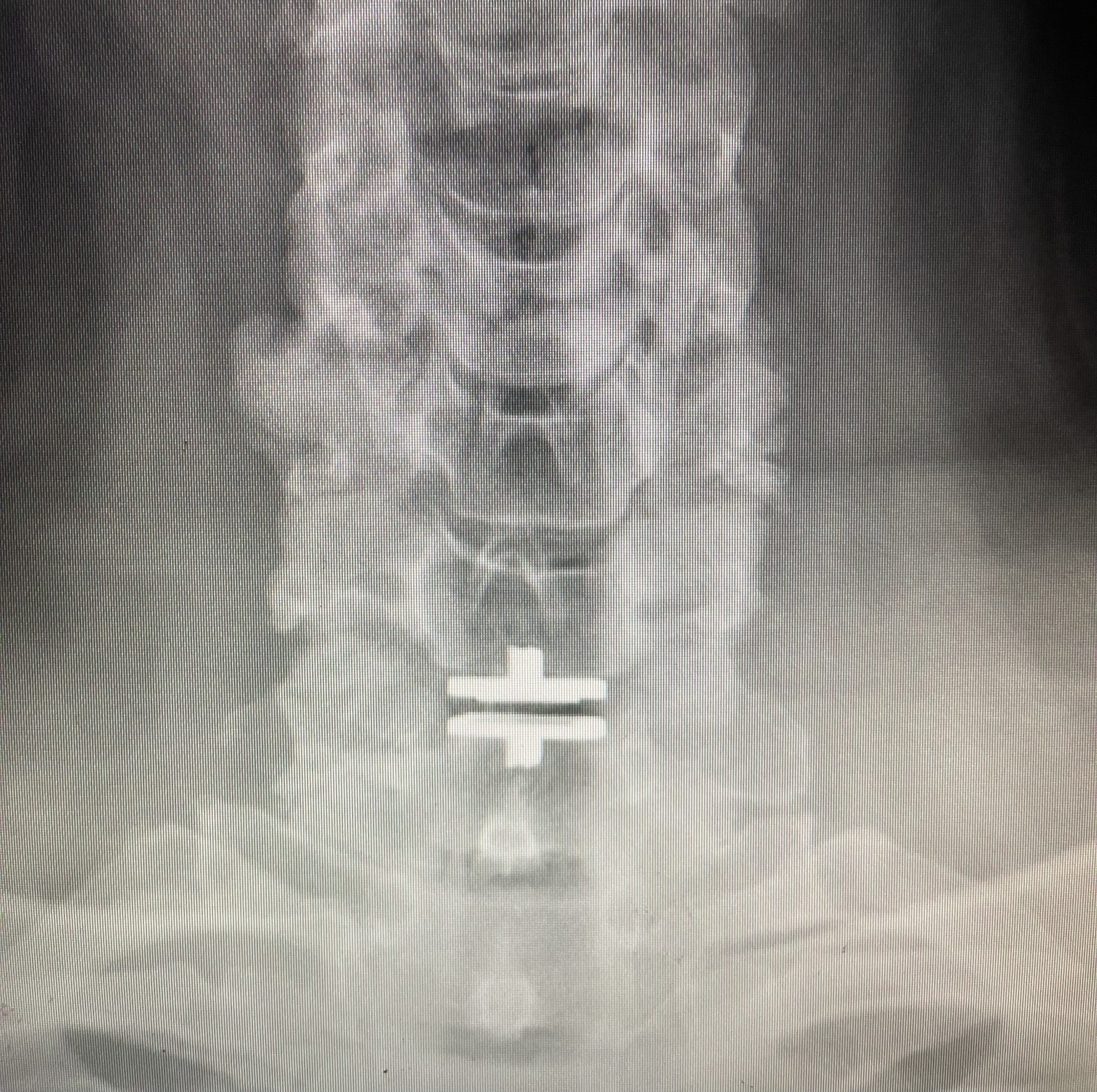 Cervical Spine Reanimation – Dr. Larson Navigates a New Frontier